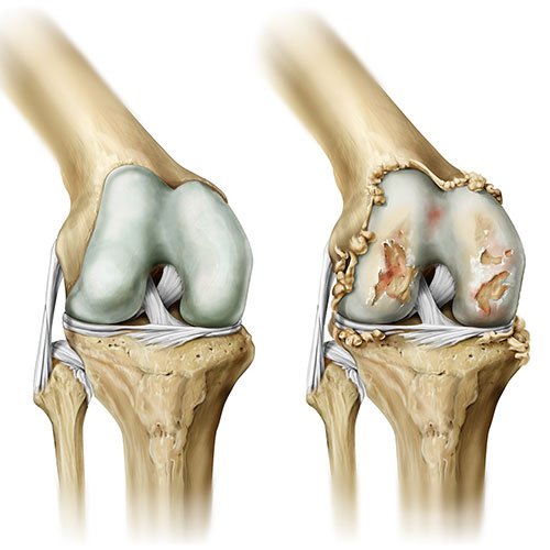 Artrosis de rodilla