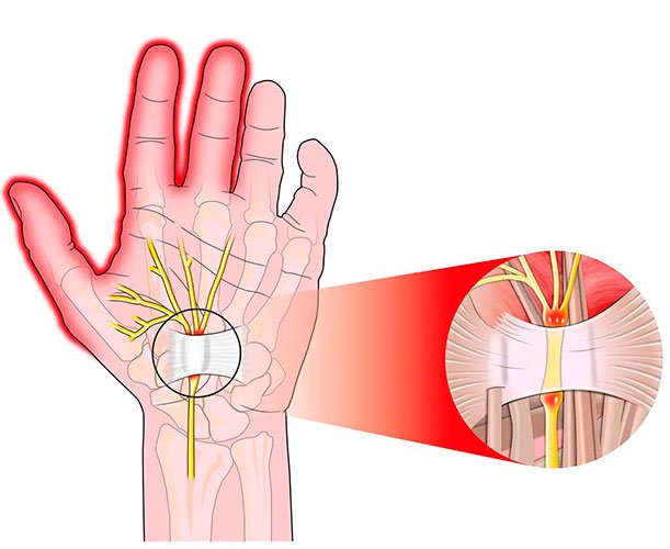 Túnel carpiano